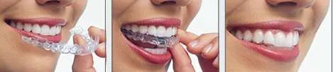 ¿Como funciona Invisalign? ¿Como funciona Invisalign?