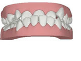 Protrusión Protrusión