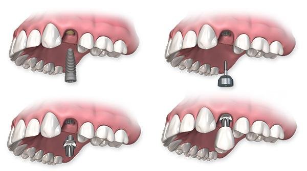 Tipos implantes Carga Inmediata Tipos implantes Carga Inmediata