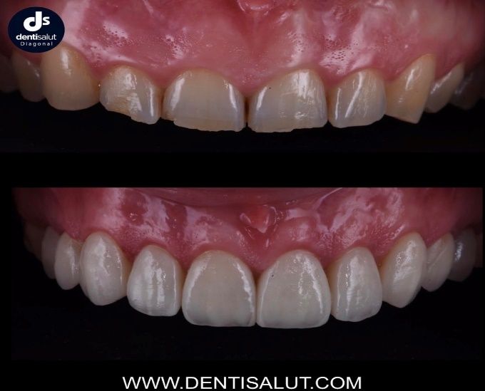 Tratamiento estética dental antes y después Tratamiento estética dental antes y después