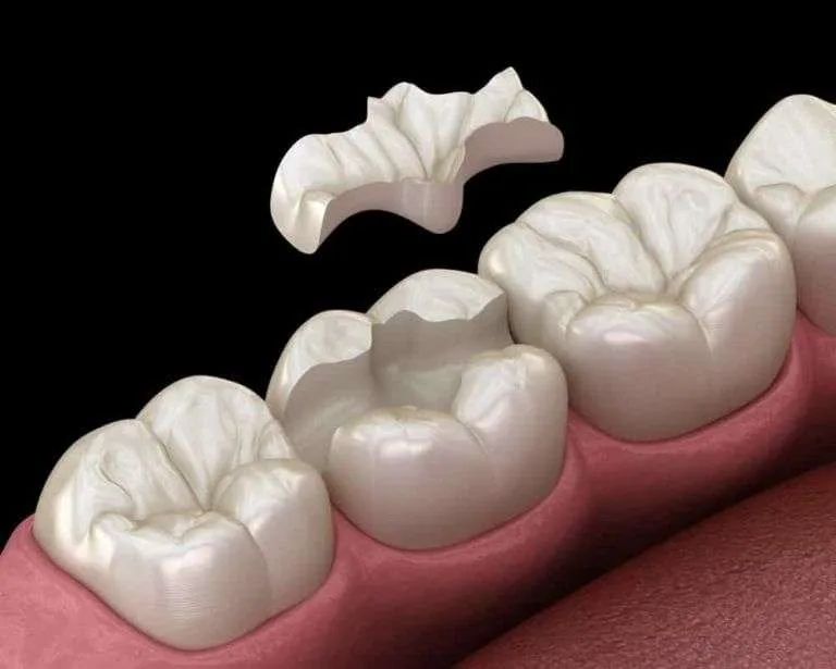 Incrustación dental Incrustación dental