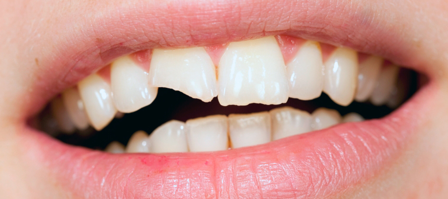 ¿Qué es la reconstrucción dental?