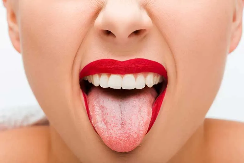 candidiasis-bucal-dentisalut