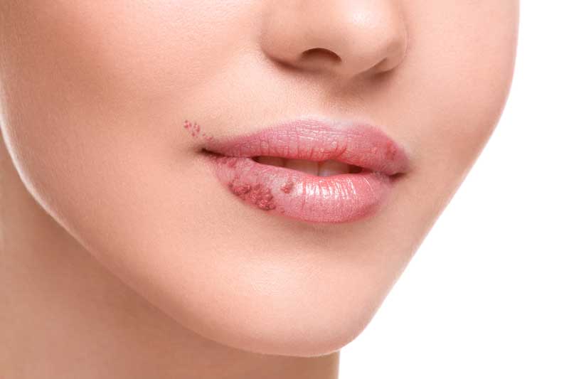 herpes-labial-dentisalut