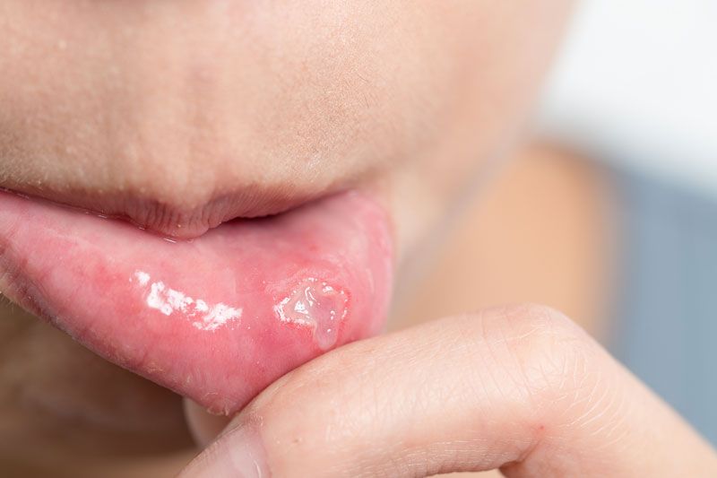 llaga-o-aftas-dentisalut