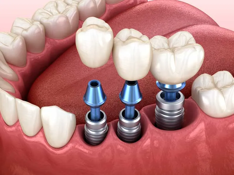 Tiempo de recuperación tras colocación de implantes dentales Tiempo de recuperación tras colocación de implantes dentales