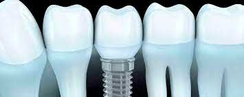 Tipos de prótesis sobre implantes Tipos de prótesis sobre implantes