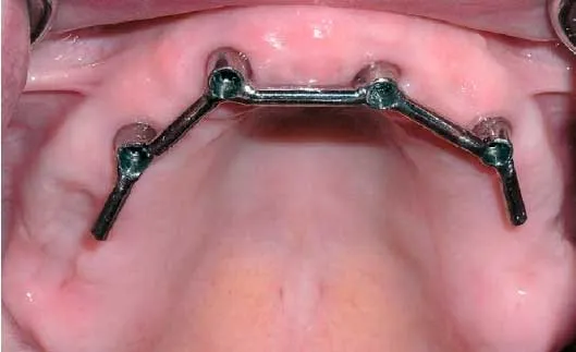 Tipos de prótesis sobre implantes Tipos de prótesis sobre implantes