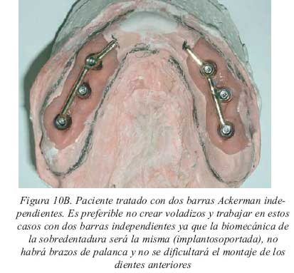 Tipos de prótesis sobre implantes Tipos de prótesis sobre implantes