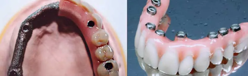 Tipos de prótesis sobre implantes Tipos de prótesis sobre implantes