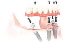 Tipos de prótesis sobre implantes Tipos de prótesis sobre implantes