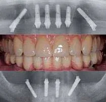 Tipos de prótesis sobre implantes Tipos de prótesis sobre implantes