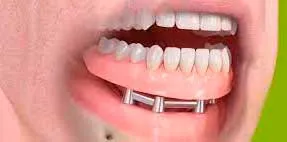 Tipos de prótesis sobre implantes Tipos de prótesis sobre implantes