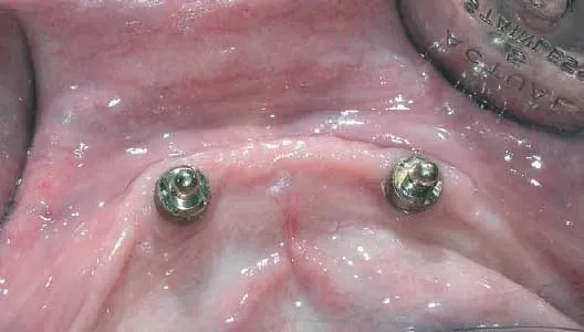 Tipos de prótesis sobre implantes