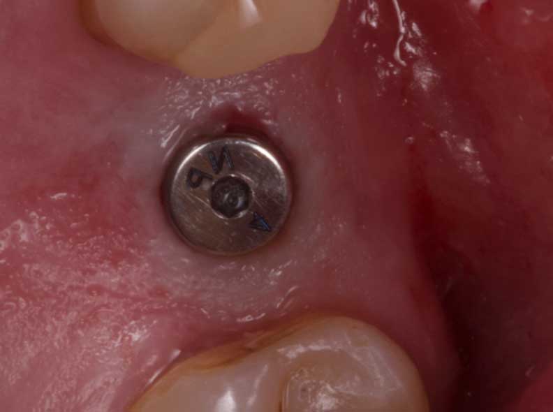 implantes-con-cirugia-guiada-2